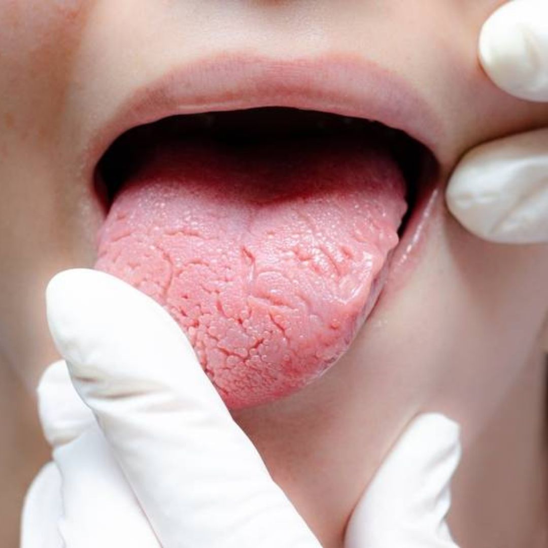 Propolis et bromélaïne contre la candidose Candida albicans