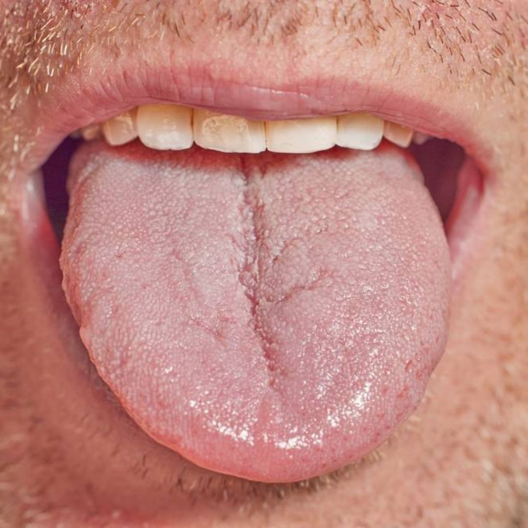 Candidose : prévention, symptômes et traitement naturel