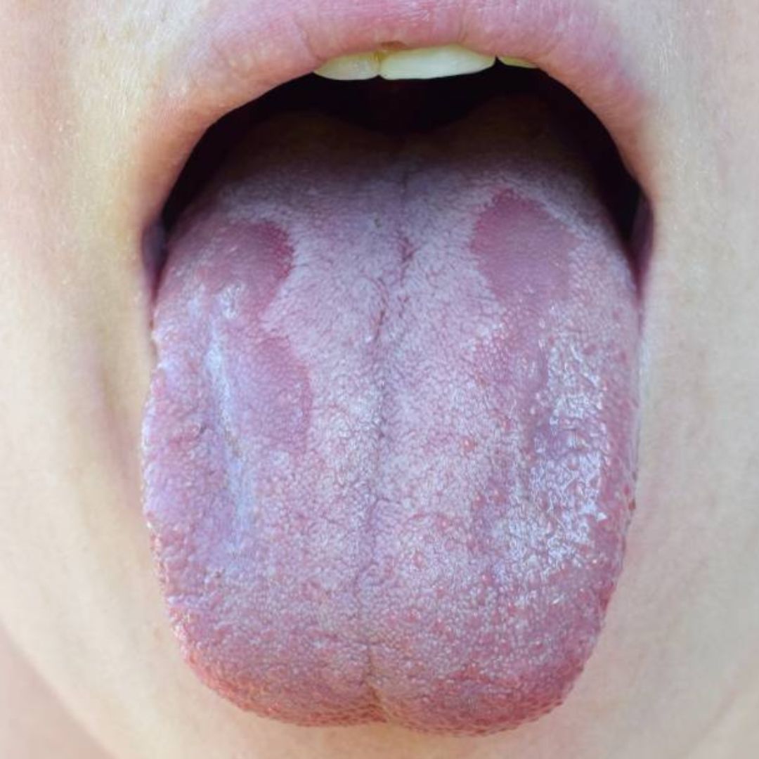 Remèdes naturels pour combattre la candidose