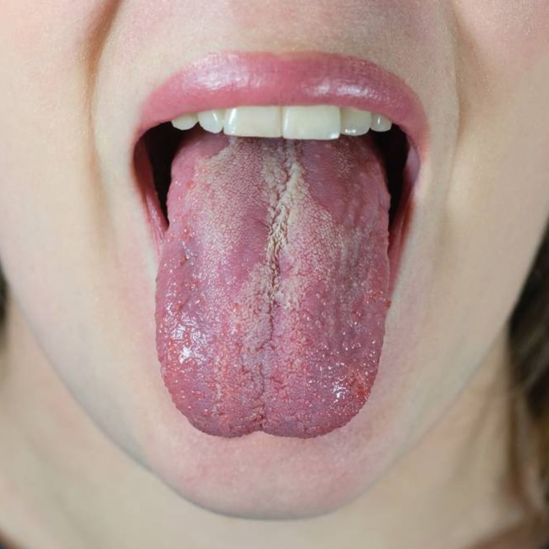 Pourquoi prendre des compléments alimentaires lorsque l'on a une candidose ?