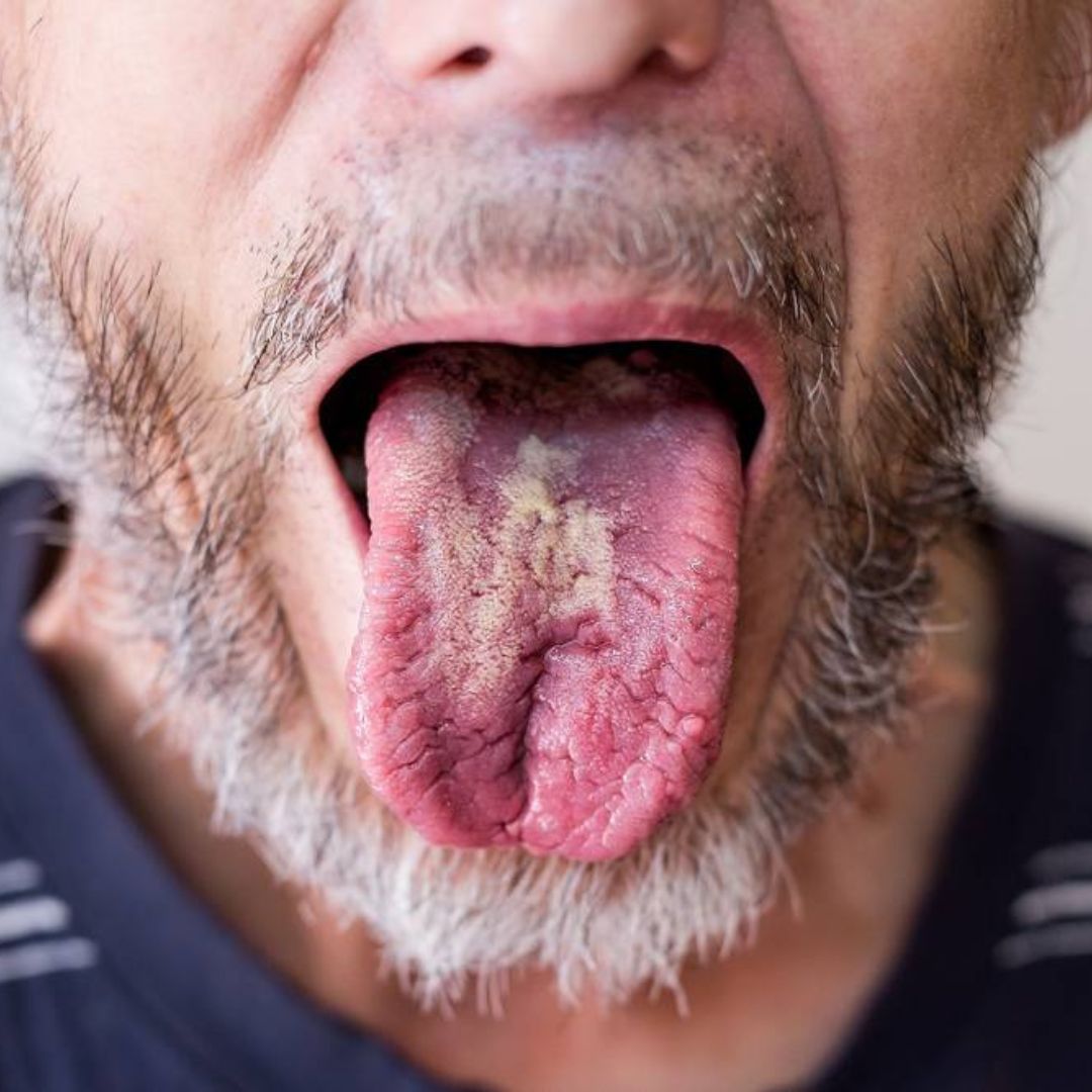 Présence excessive du Candida Albicans : quelles causes ?