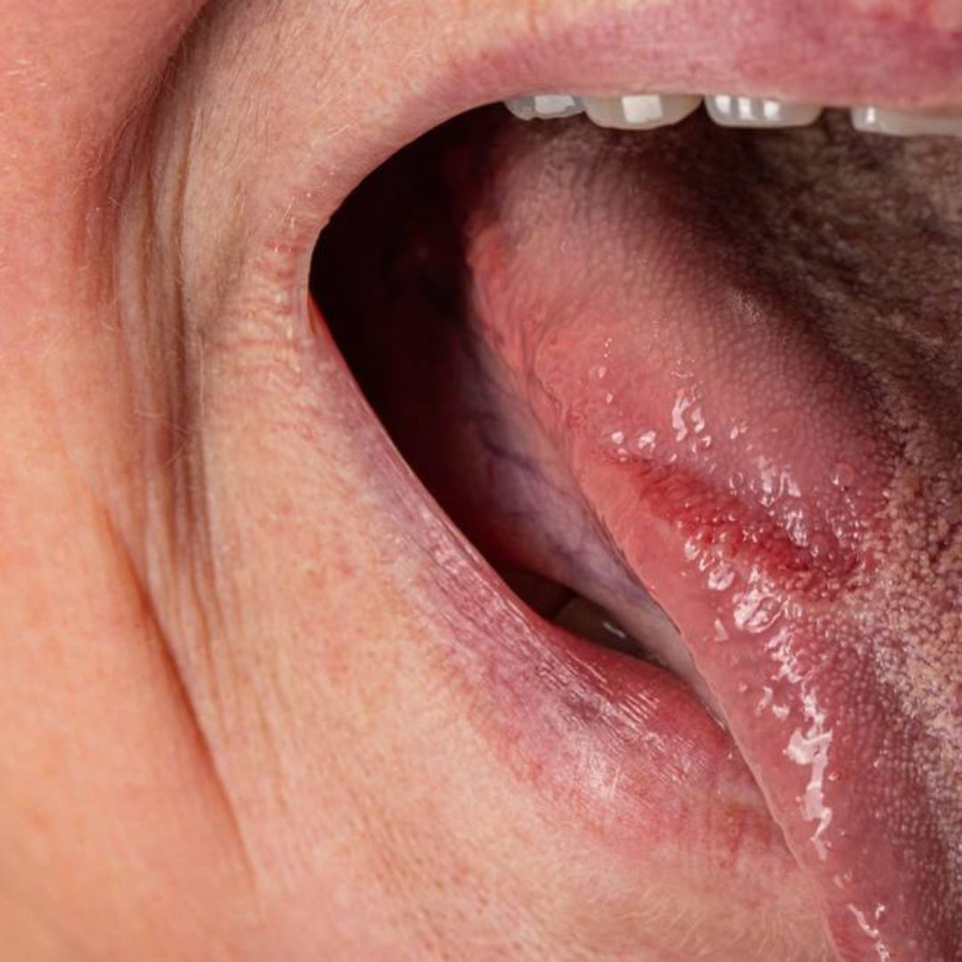 Allergies et candidose : comprendre les liens et les solutions