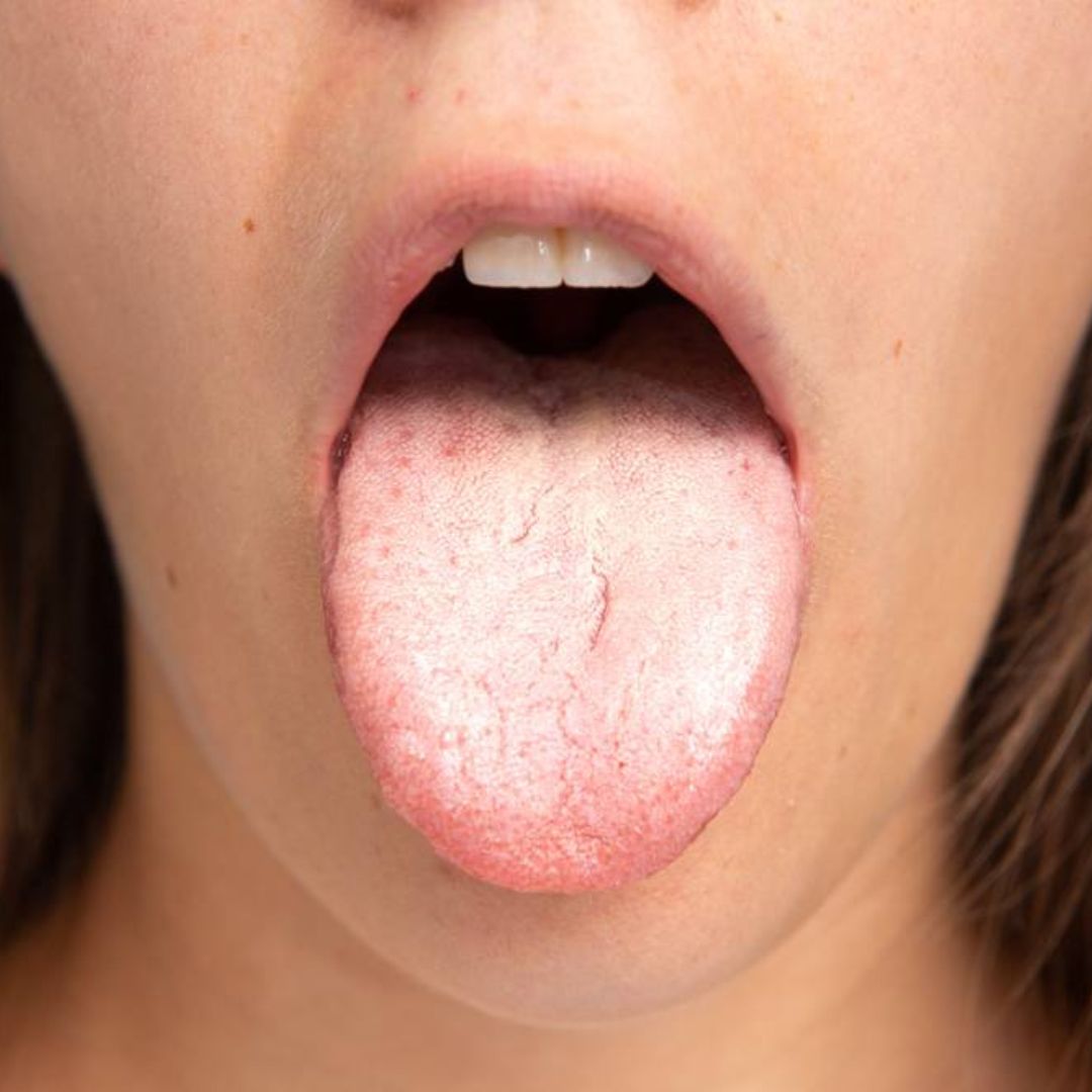 Décrypter l'influence de l'envie de manger sucré sur la candidose