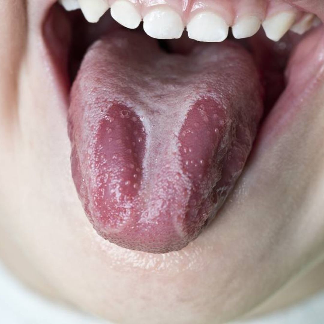 Comprendre les symptômes de la candidose : un guide complet