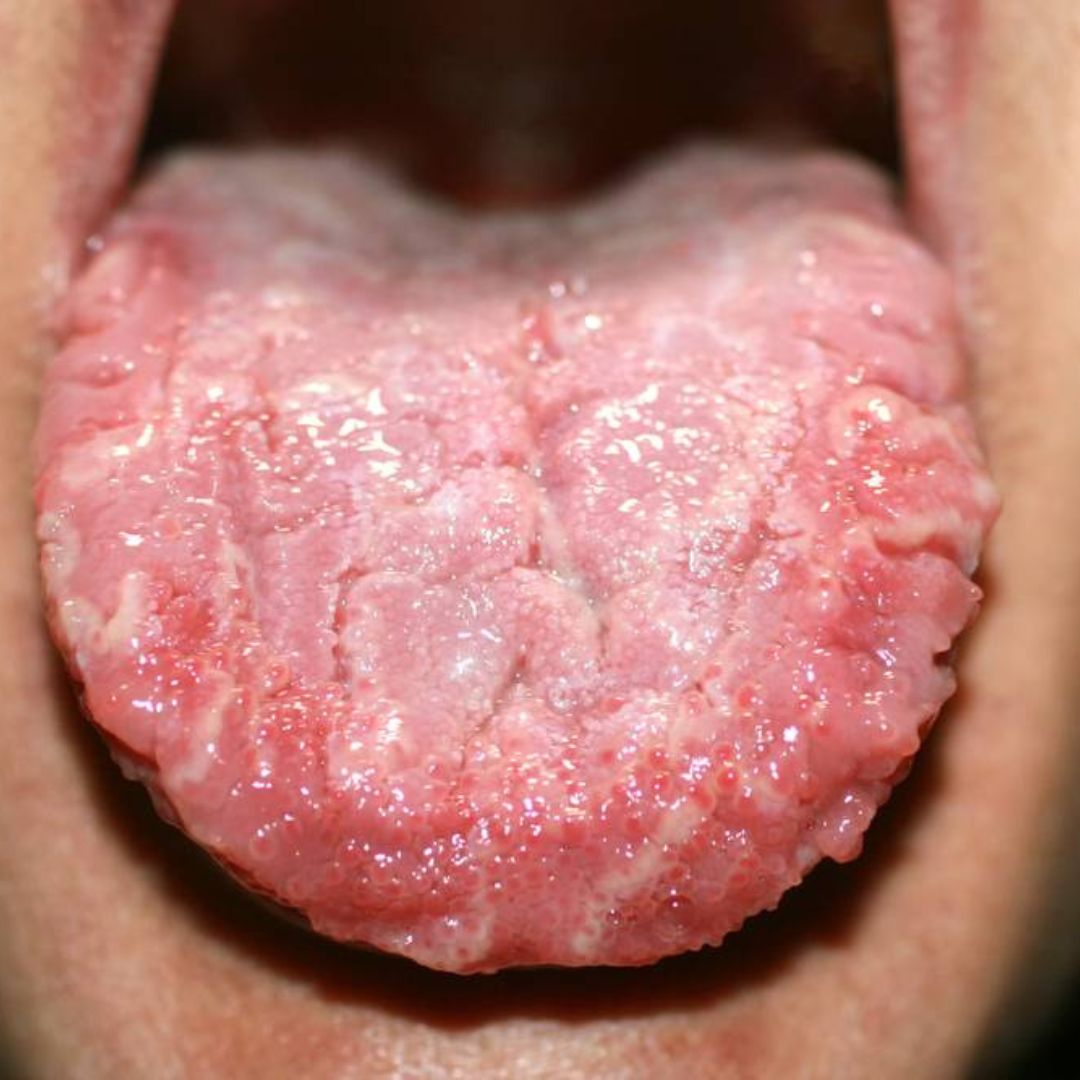 Candidose de type systémique : comprendre pour mieux contrer