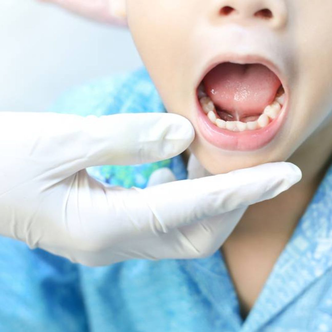 Quels traitements pour soigner une candidose ?