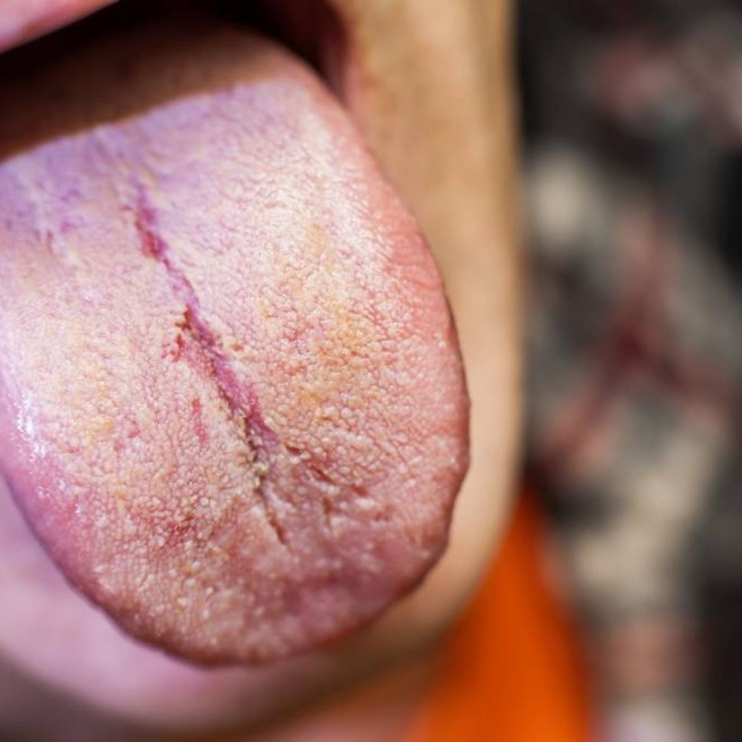 Comment soigner une candidose ?