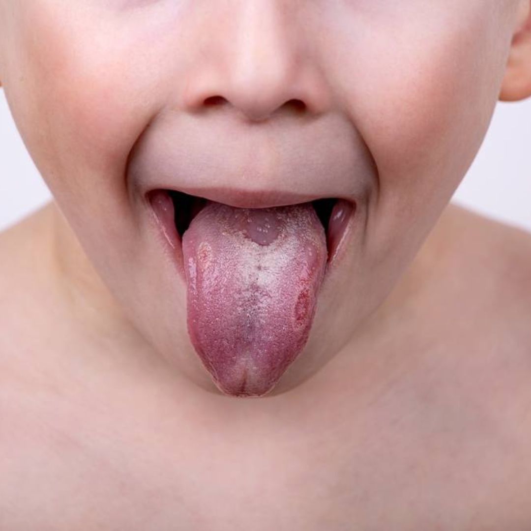 Candida albicans et fragilisation de la flore microbienne