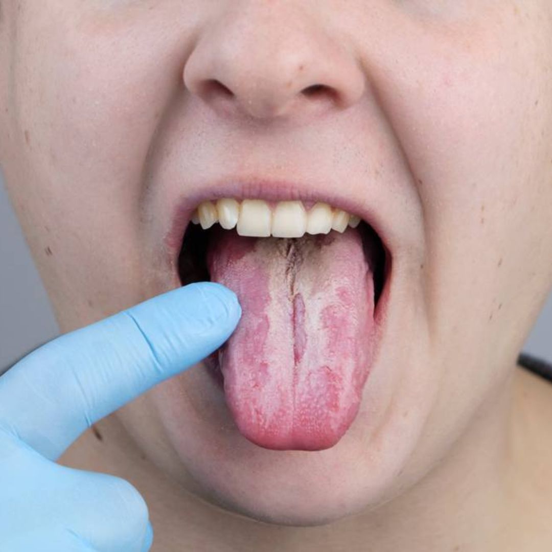 Tout savoir sur la candidose