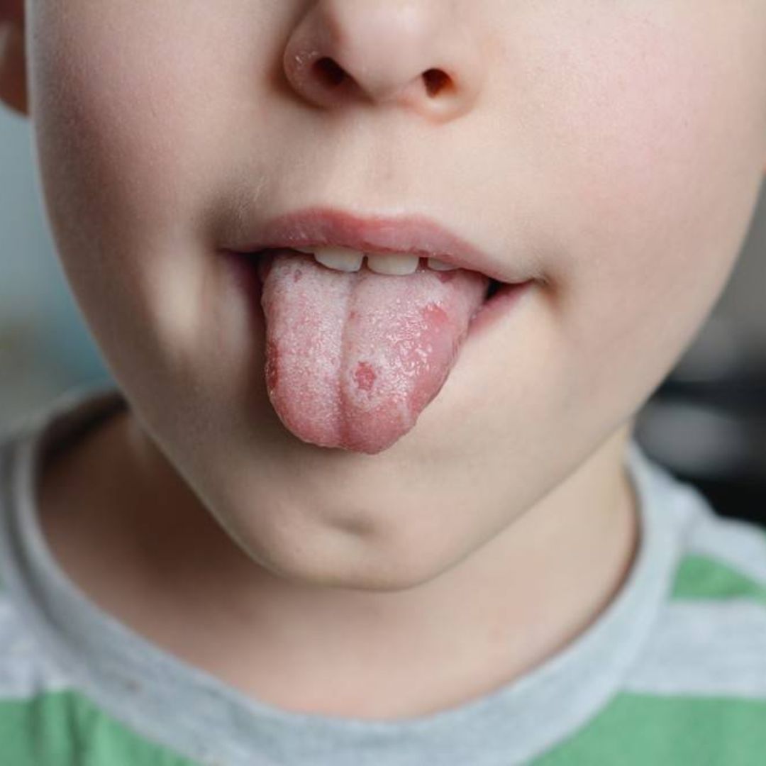 Candidose : formes, symptômes et traitement de l'infection à Candida