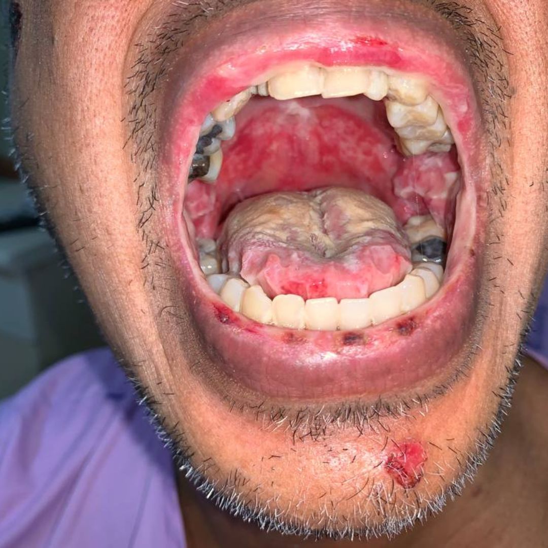 Mycose et candidose cutanée : symptômes, traitement