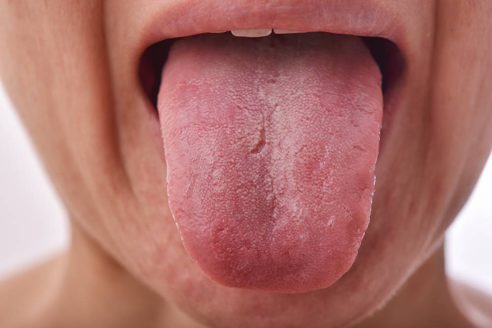 Quels sont les symptomes de la candidose ?-2